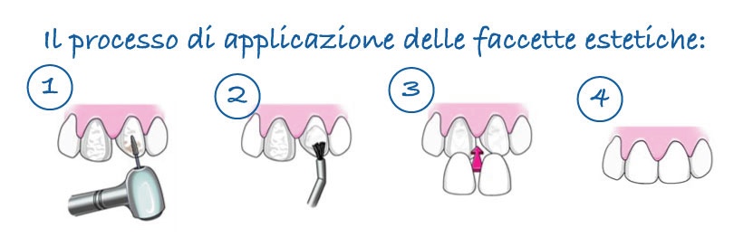 Faccette dentali quanto costano | Dentista Parma