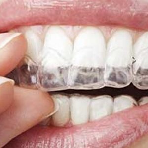 ALLINEAMENTO DENTI INVISIBILE | Dentisti Parma Akos Dental Care: il giusto Sorriso in tempi rapidi e con trattamento indolore