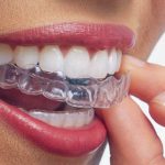 ALLINEAMENTO DENTI INVISIBILE | Dentisti Parma Akos Dental Care: il giusto Sorriso in tempi rapidi e con trattamento indolore