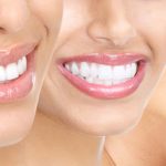 SPECIALISTI IN ESTETICA DENTALE | Dentisti Parma Akos Dental Care: il giusto Sorriso in tempi rapidi e con trattamento indolore