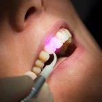 La Parodontite si cura con il Laser da AKOS Centro Odontoiatrico! Parma Carpi Modena Reggio Emilia Mantova