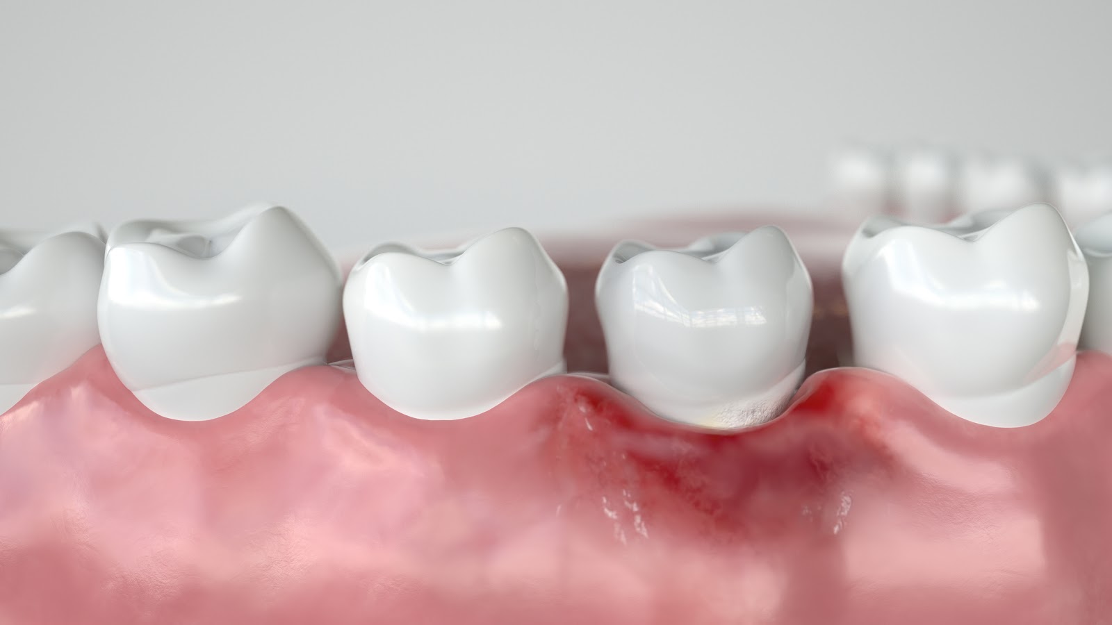 Ascesso dentale: sintomi e cura | Dentisti AKOS Centro Odontoiatrico Dentisti a Parma Carpi Modena Reggio Emilia Mantova