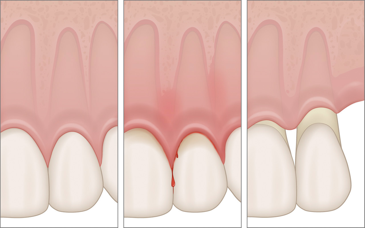 Recessione gengivale ovvero gengive ritirate | AKOS Centro Odontoiatrico Dentisti a Parma Carpi Modena Reggio Emilia Mantova