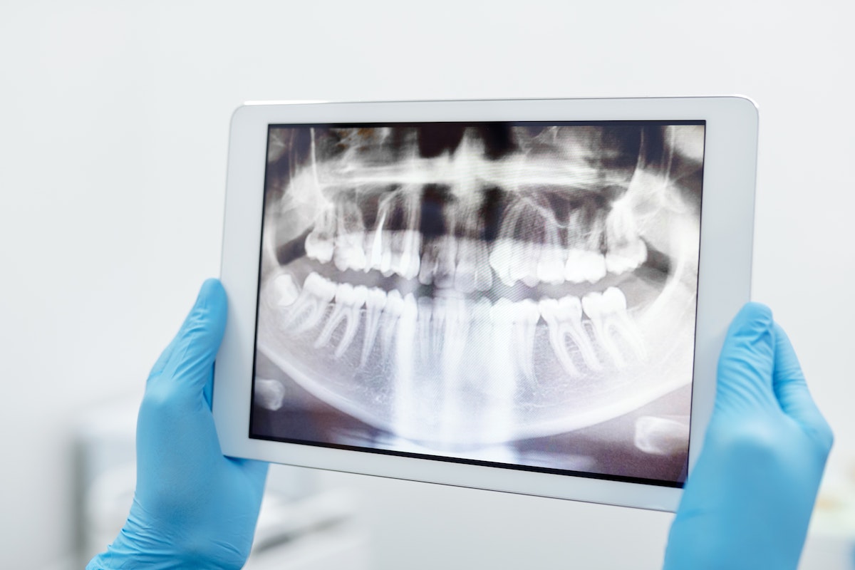 Implantologia Dentale Non Invasiva Senza Bisturi Traumi Errori Punti Parma Carpi Modena Reggio Emilia | AKOS Dental Care