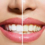 OPEN DAY di Ortodonzia invisibile il 28 giugno da AKOS con Nuvola® Allineatori Dentali Trasparenti | Centro Dentale Parma Via Gramsci 18/1
