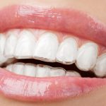 Ortodonzia invisibile AKOS con Nuvola® Allineatori Dentali | Centro Dentale AKOS Dental Care Parma Via Gramsci 18/1