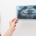 A cosa serve la rigenerazione ossea dentale | AKOS Centro Odontoiatrico Parma Piacenza Casalmaggiore Fidenza Cremona