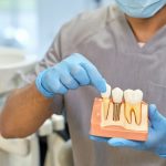Rigenerazione ossea per impianti dentali | AKOS Centro Odontoiatrico Parma Piacenza Casalmaggiore Fidenza Cremona