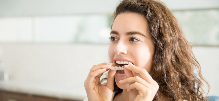 Alineatori dentali trasparenti per bambini e ragazzi