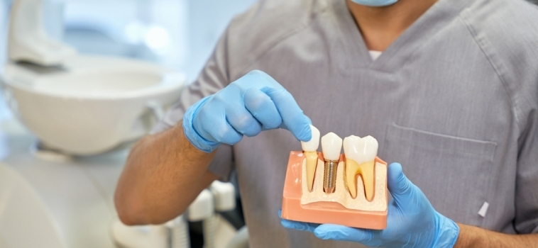 Rigenerazione ossea per impianti dentali