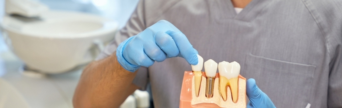 Rigenerazione ossea per impianti dentali