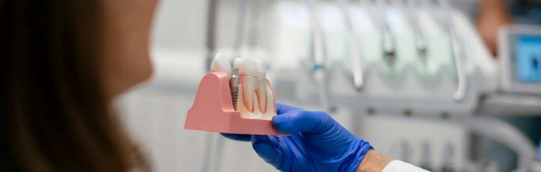 Gli impianti dentali dopo la rigenerazione ossea dentale