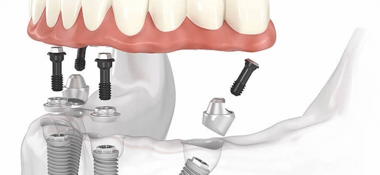 Impianti Dentali All on four 4 con Chirurgia Guidata