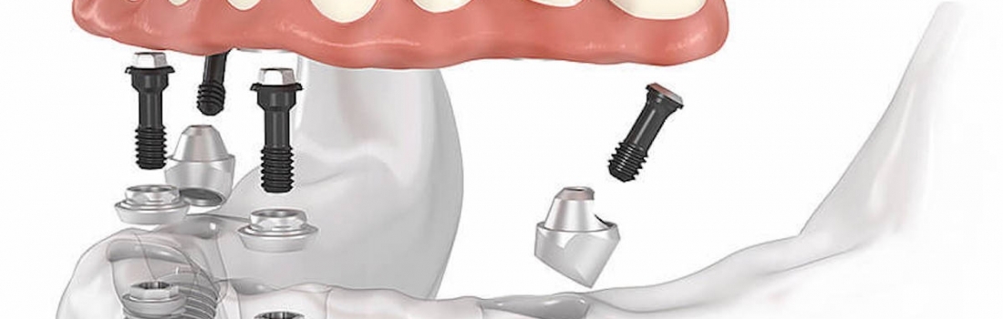 Impianti Dentali All on four 4 con Chirurgia Guidata