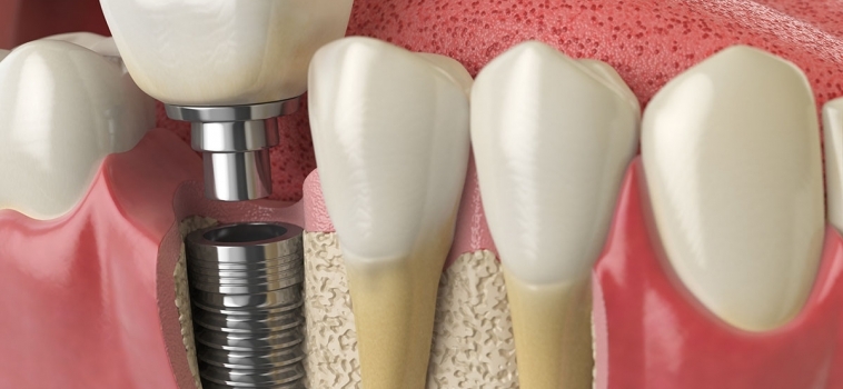 Impianti Dentali e il risparmio che non conviene