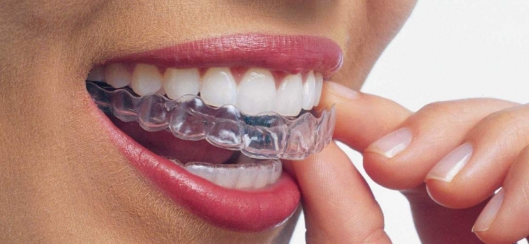 ALLINEAMENTO DENTI INVISIBILE