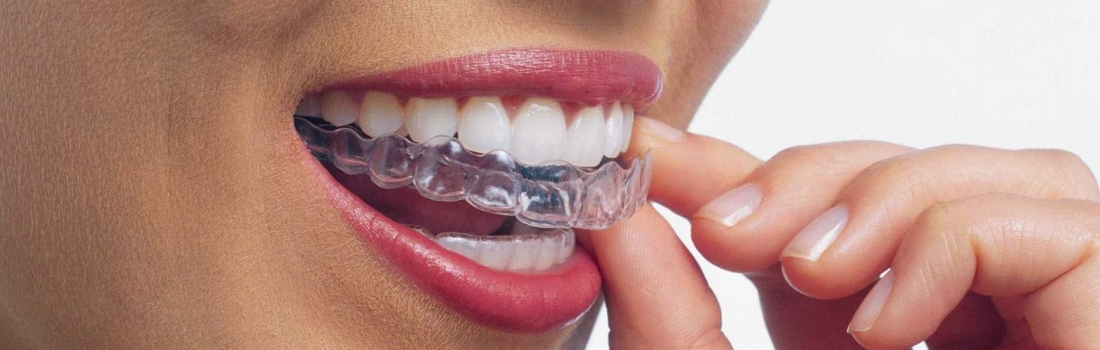 ALLINEAMENTO DENTI INVISIBILE