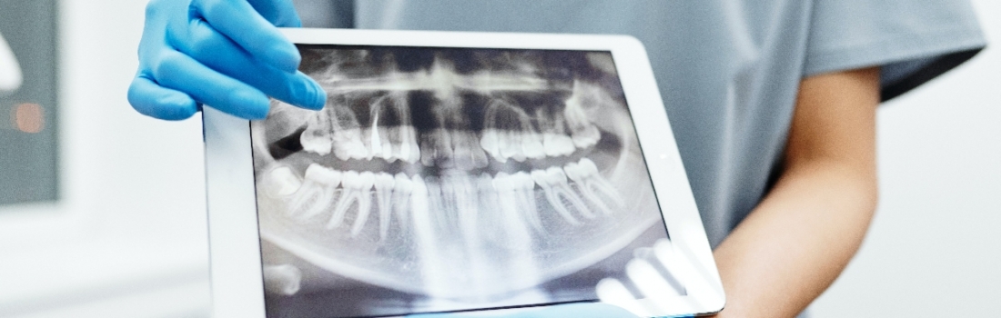 Toronto: Impianto Dentale con Chirurgia Guidata