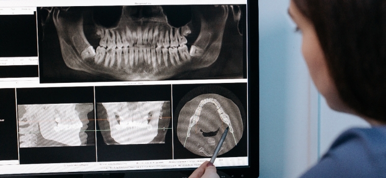 Implantologia Dentale Arcata Superiore e Inferiore