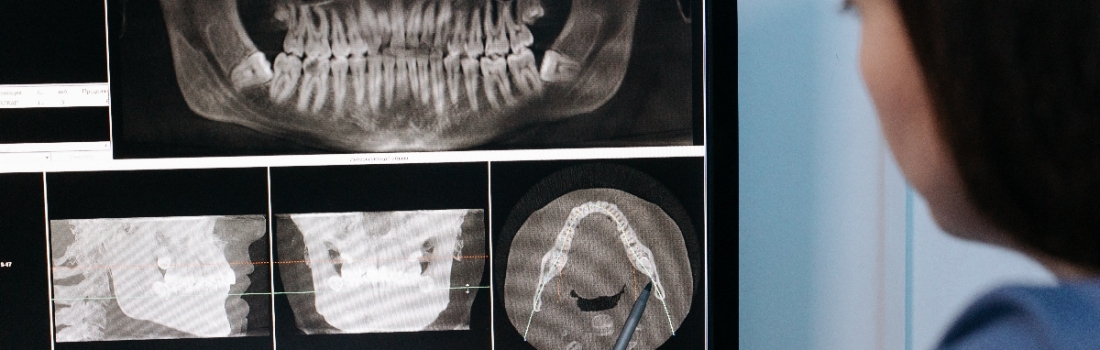 Implantologia Dentale Arcata Superiore e Inferiore