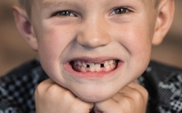 Malocclusione dentale nei bambini e ortodonzia intercettiva