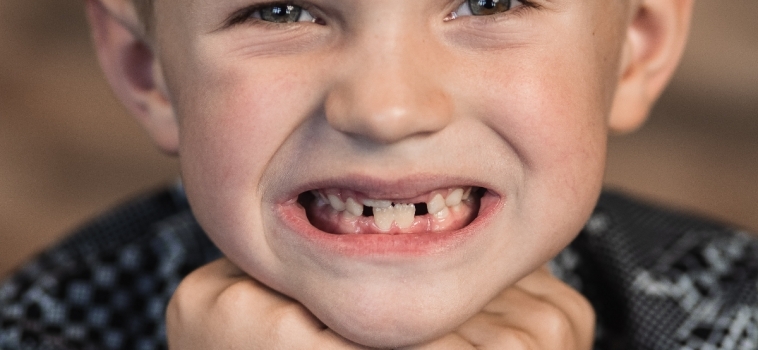 Malocclusione dentale nei bambini e ortodonzia intercettiva