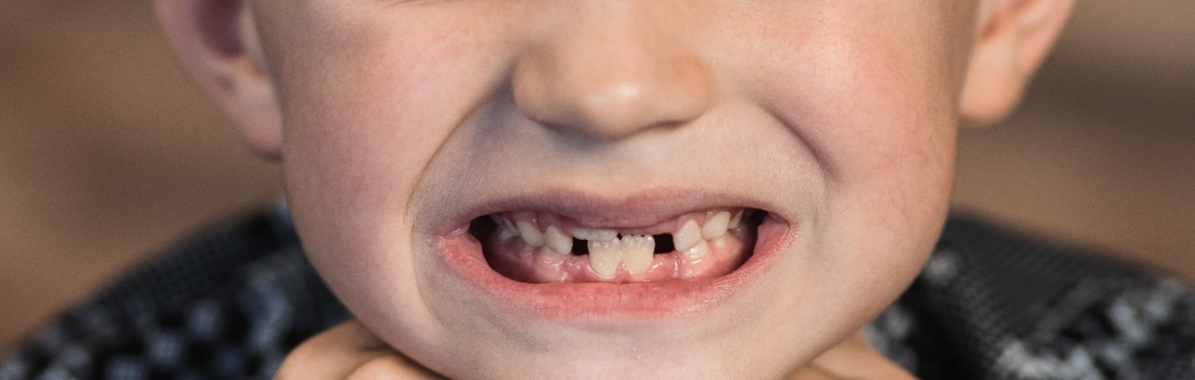 Malocclusione dentale nei bambini e ortodonzia intercettiva